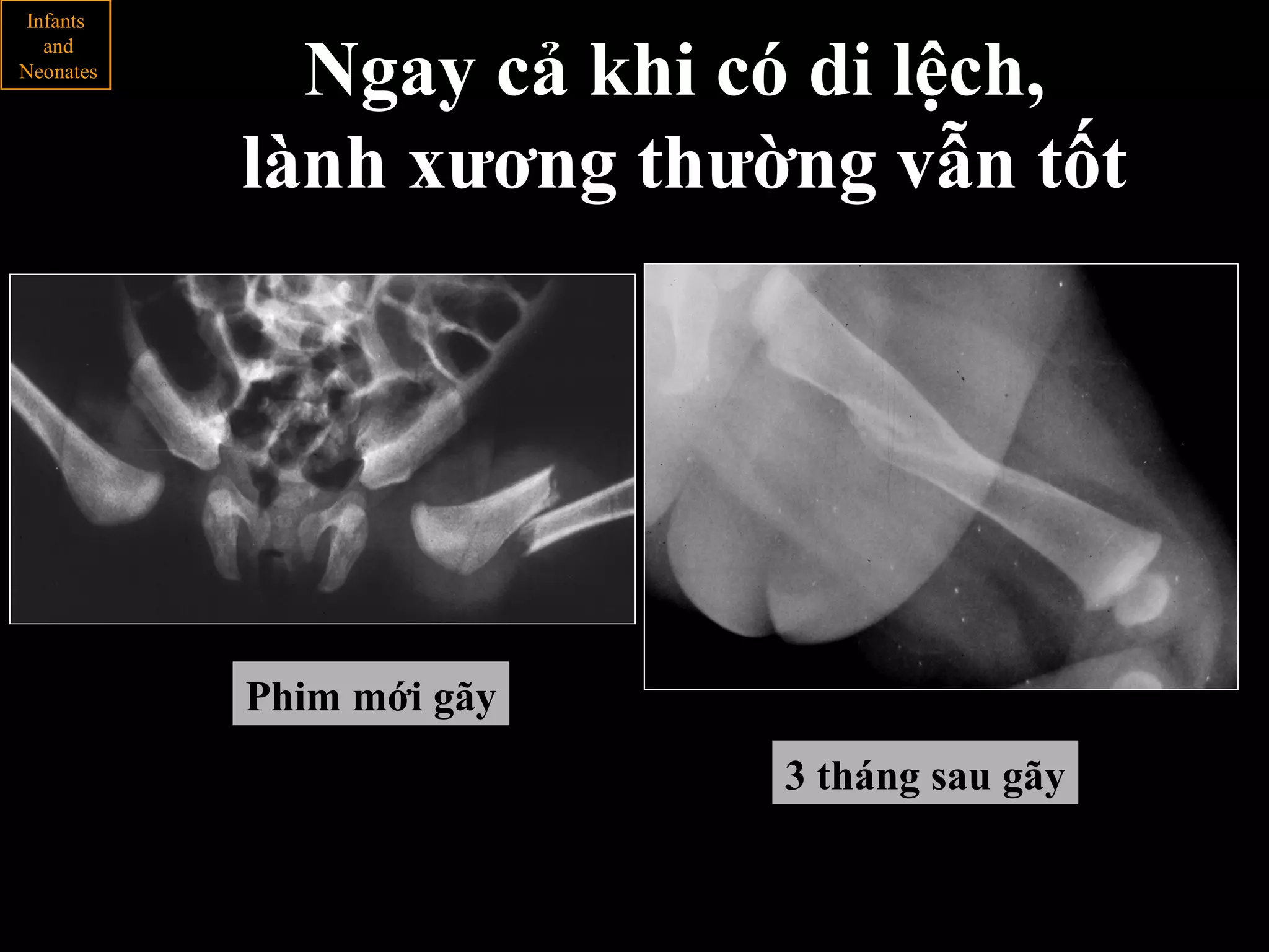 Phim mới gãy
3 tháng sau gãy
Infants
and
Neonates
Ngay cả khi có di lệch,
lành xương thường vẫn tốt
 