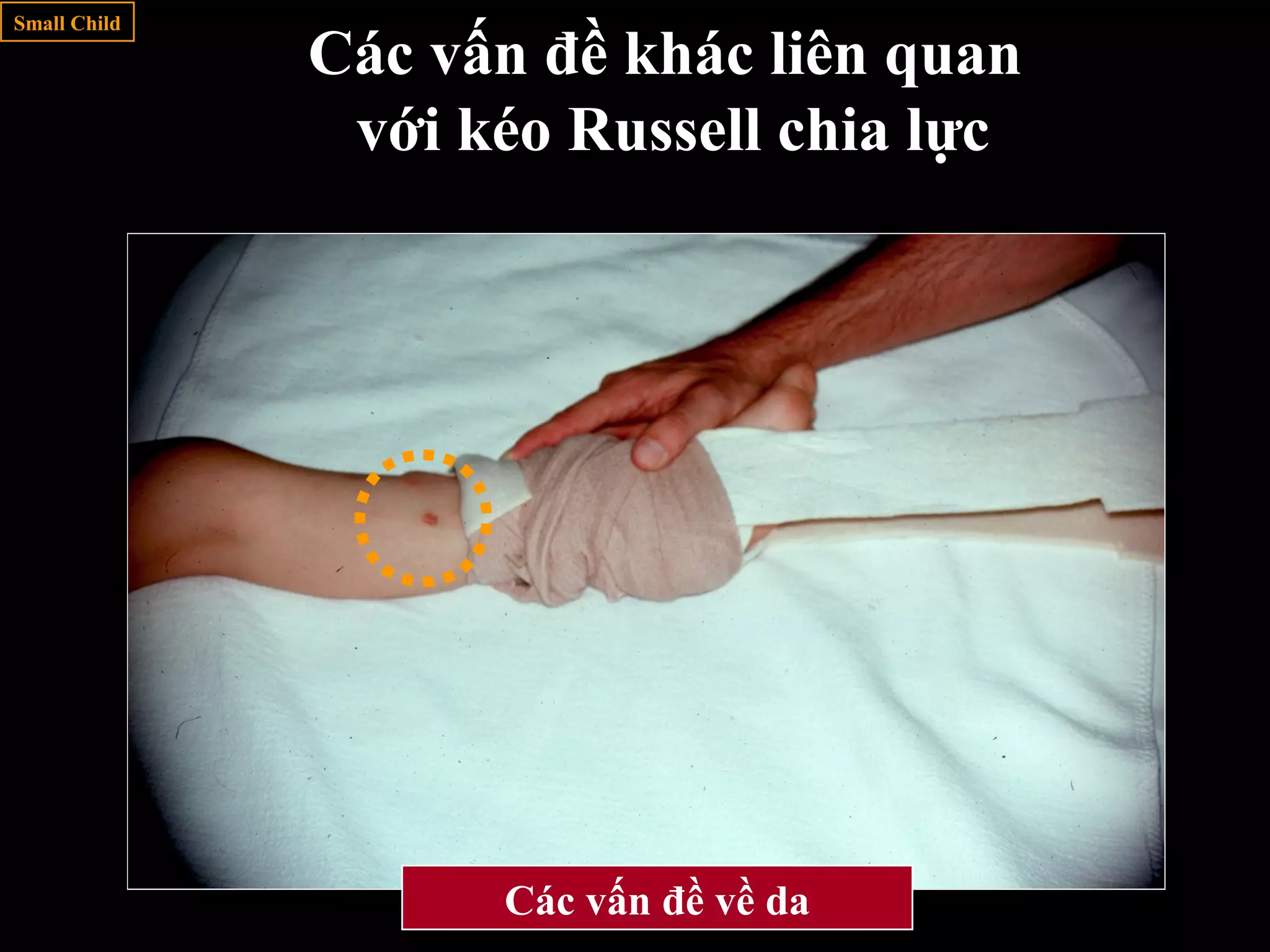 Subsequent PositionsCác vấn đề về da
Small Child
Các vấn đề khác liên quan
với kéo Russell chia lực
 