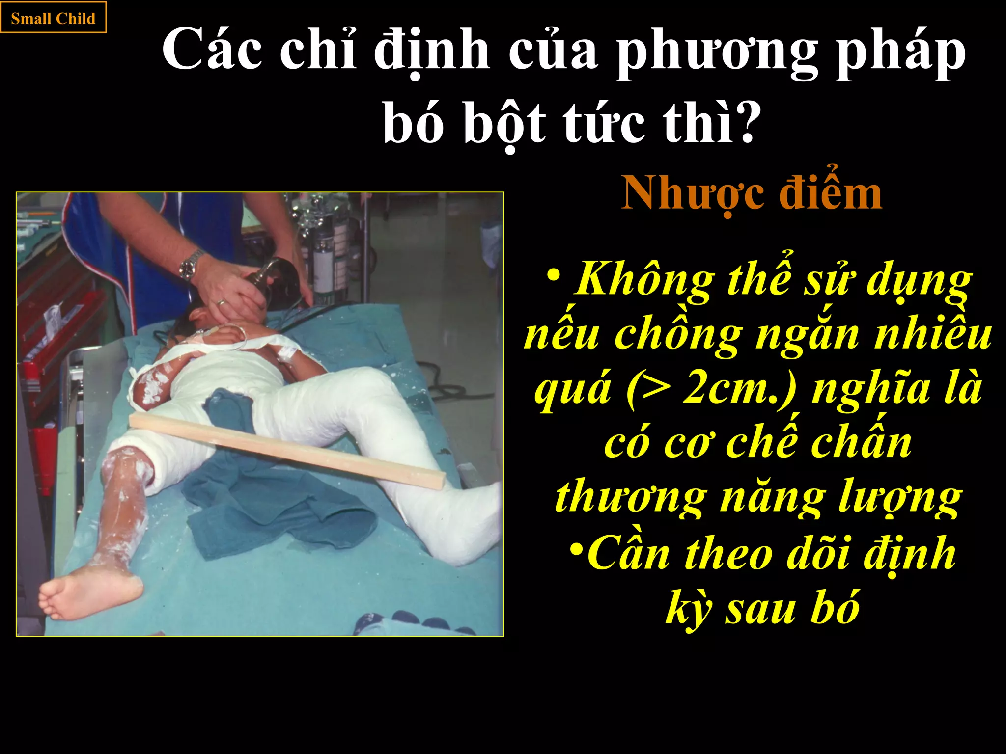 s
Ưu điểm
• Thời gian nằm viện
ngắn
• Không mắc
• Có thể dùng với
thuốc an thần (có thể
gây mê sẽ dễ bó bột
hơn)
Small Child
Các chỉ định của phương pháp
bó bột tức thì?
Nhược điểm
• Không thể sử dụng
nếu chồng ngắn nhiều
quá (> 2cm.) nghĩa là
có cơ chế chấn
thương năng lượng
cao•Cần chú ý từng
chi tiết kỹ thuật
•Cần theo dõi định
kỳ sau bó
 