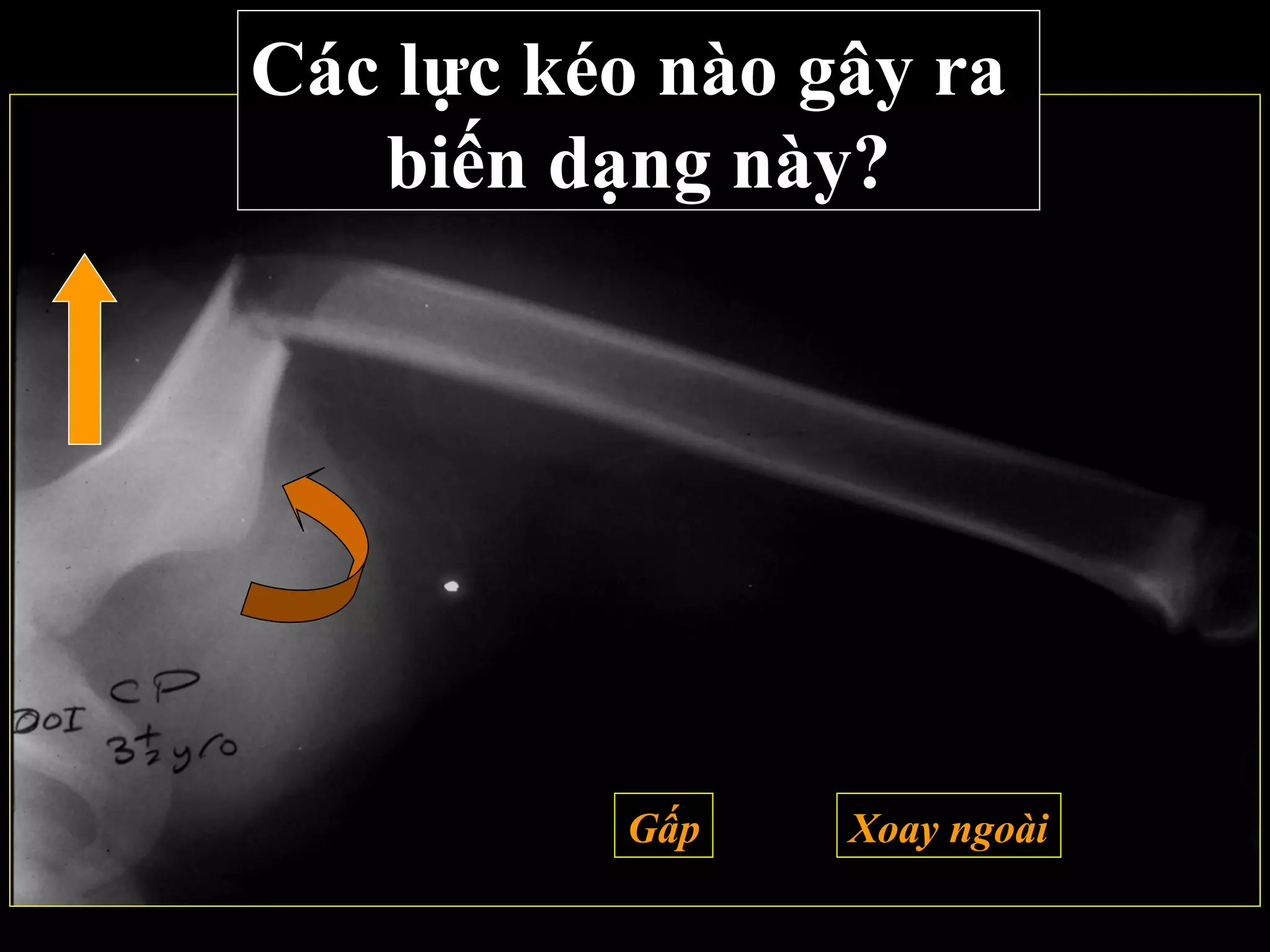 Các lực kéo nào gây ra
biến dạng này?
Xoay ngoàiGấp
 