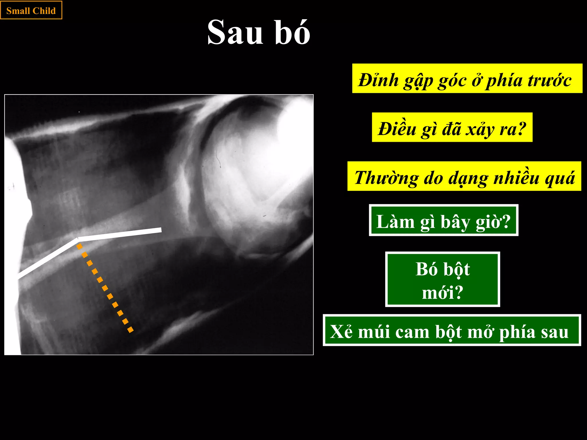 Đỉnh gập góc ở phía trước
Xẻ múi cam bột mở phía sau
Điều gì đã xảy ra?
Small Child
Sau bó
Làm gì bây giờ?
Thường do dạng nhiều quá
Bó bột
mới?
 