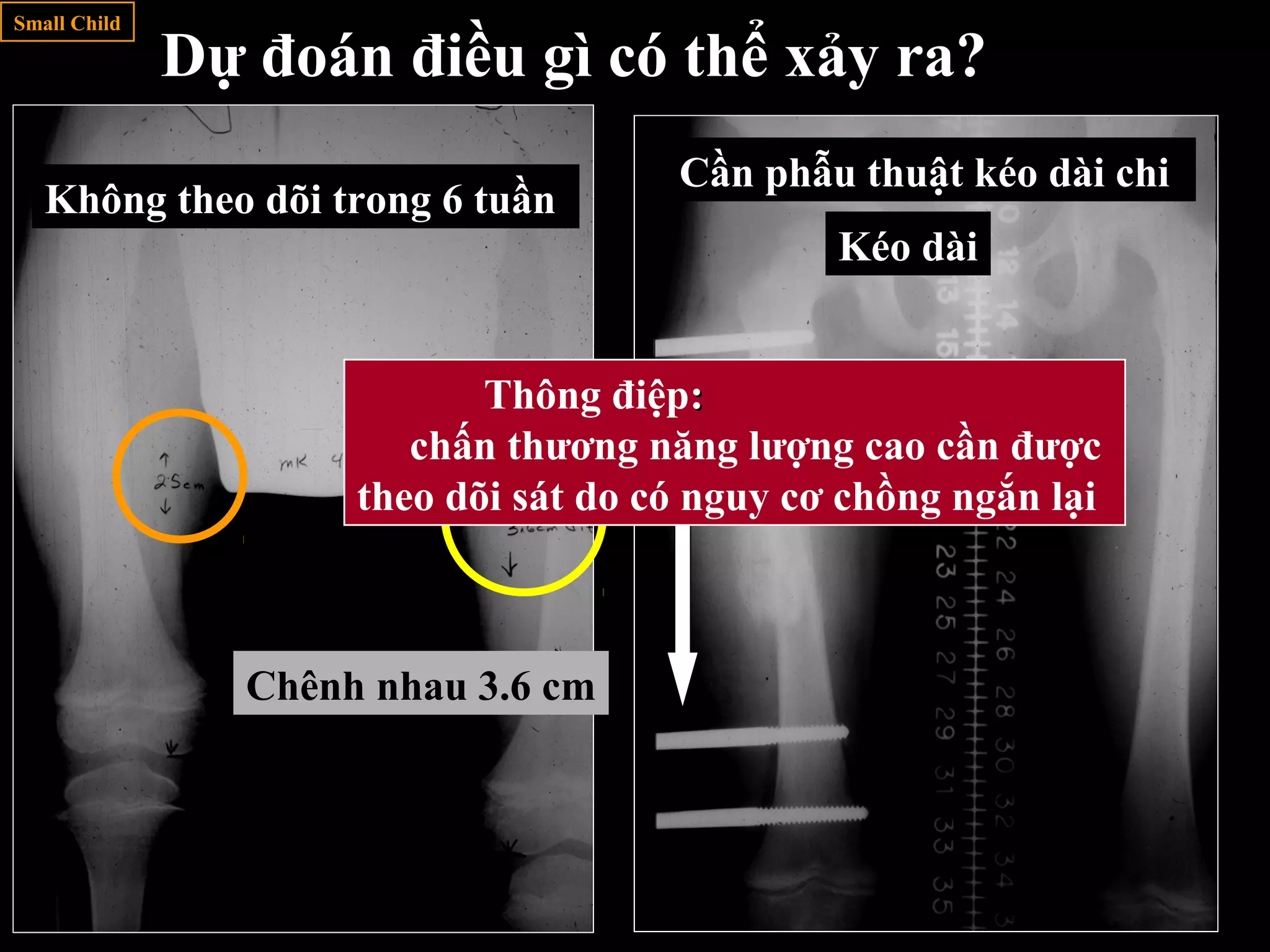 Làm gì
bây giờ?
Không theo dõi trong 6 tuần
Chênh nhau 3.6 cm
Cần phẫu thuật kéo dài chi
Kéo dài
Small Child
Dự đoán điều gì có thể xảy ra?
Thông điệp::
chấn thương năng lượng cao cần được
theo dõi sát do có nguy cơ chồng ngắn lại
 