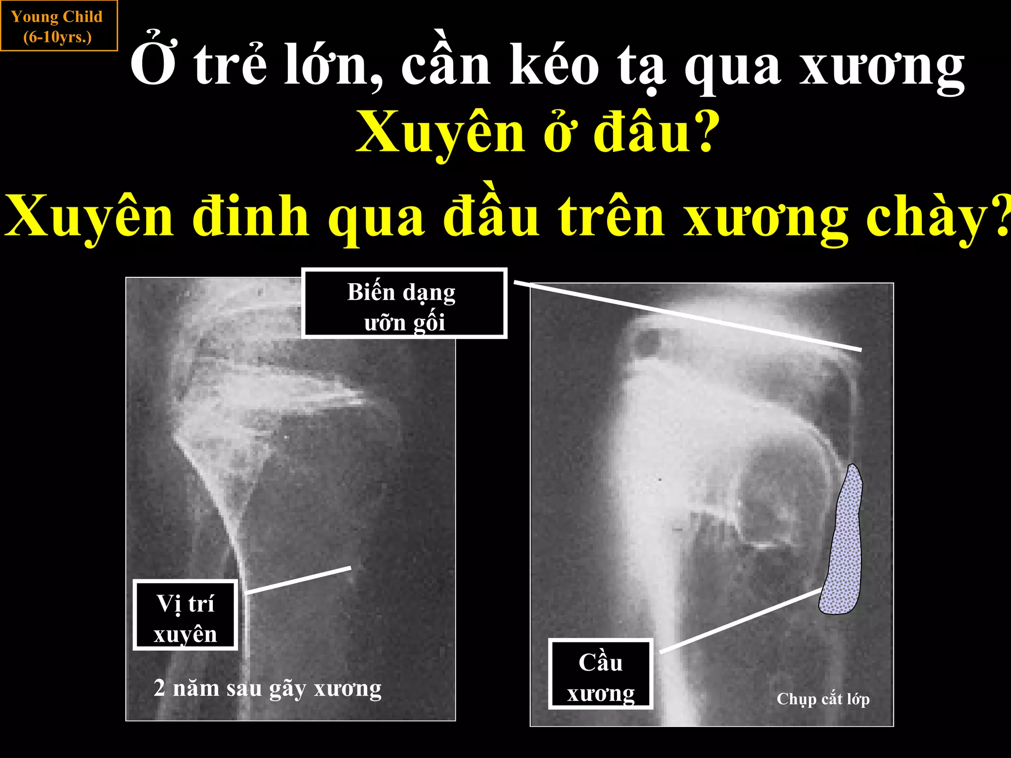 Ở trẻ lớn, cần kéo tạ qua xương
Young Child
(6-10yrs.)
Xuyên ở đâu?
Xuyên đinh qua đầu trên xương chày?
2 năm sau gãy xương
Vị trí
xuyên
Cầu
xương
Biến dạng
ưỡn gối
Chụp cắt lớp
 