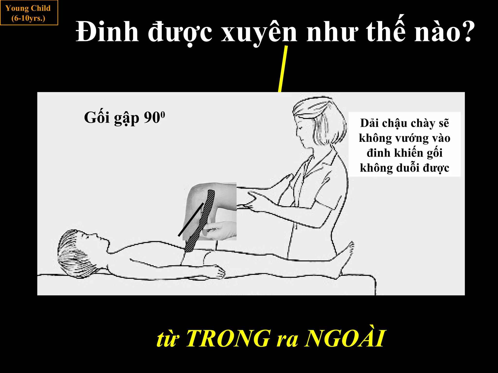 Young Child
(6-10yrs.)
Đinh được xuyên như thế nào?
Gối gập 900
Dải chậu chày
nằm ở phía sau đinh
Dải chậu chày sẽ
không vướng vào
đinh khiến gối
không duỗi được
Đinh được xuyên theo hướng nào?Từ trong ra ngoàitừ TRONG ra NGOÀI
 