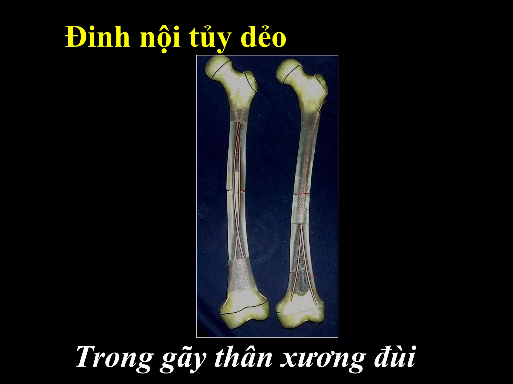 Đinh nội tủy dẻo
Trong gãy thân xương đùi
 