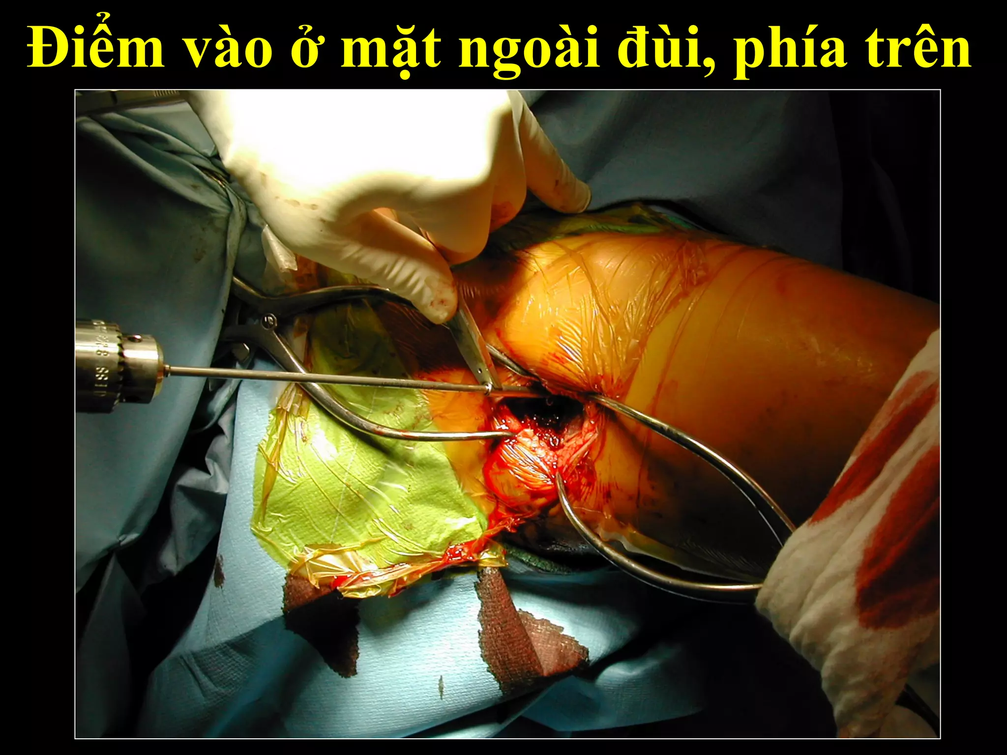 Điểm vào ở mặt ngoài đùi, phía trên
 