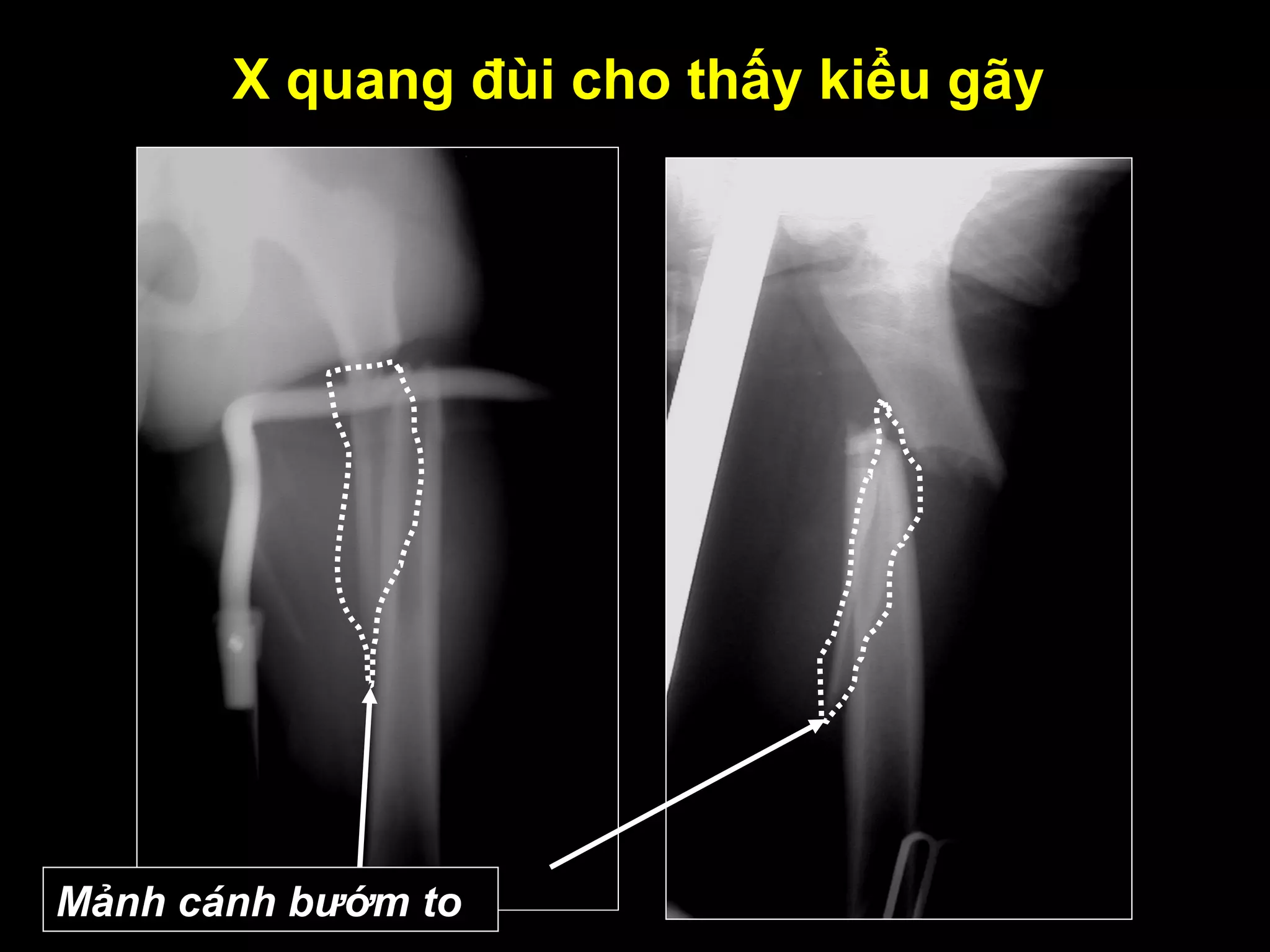 X quang đùi cho thấy kiểu gãy
Mảnh cánh bướm to
 
