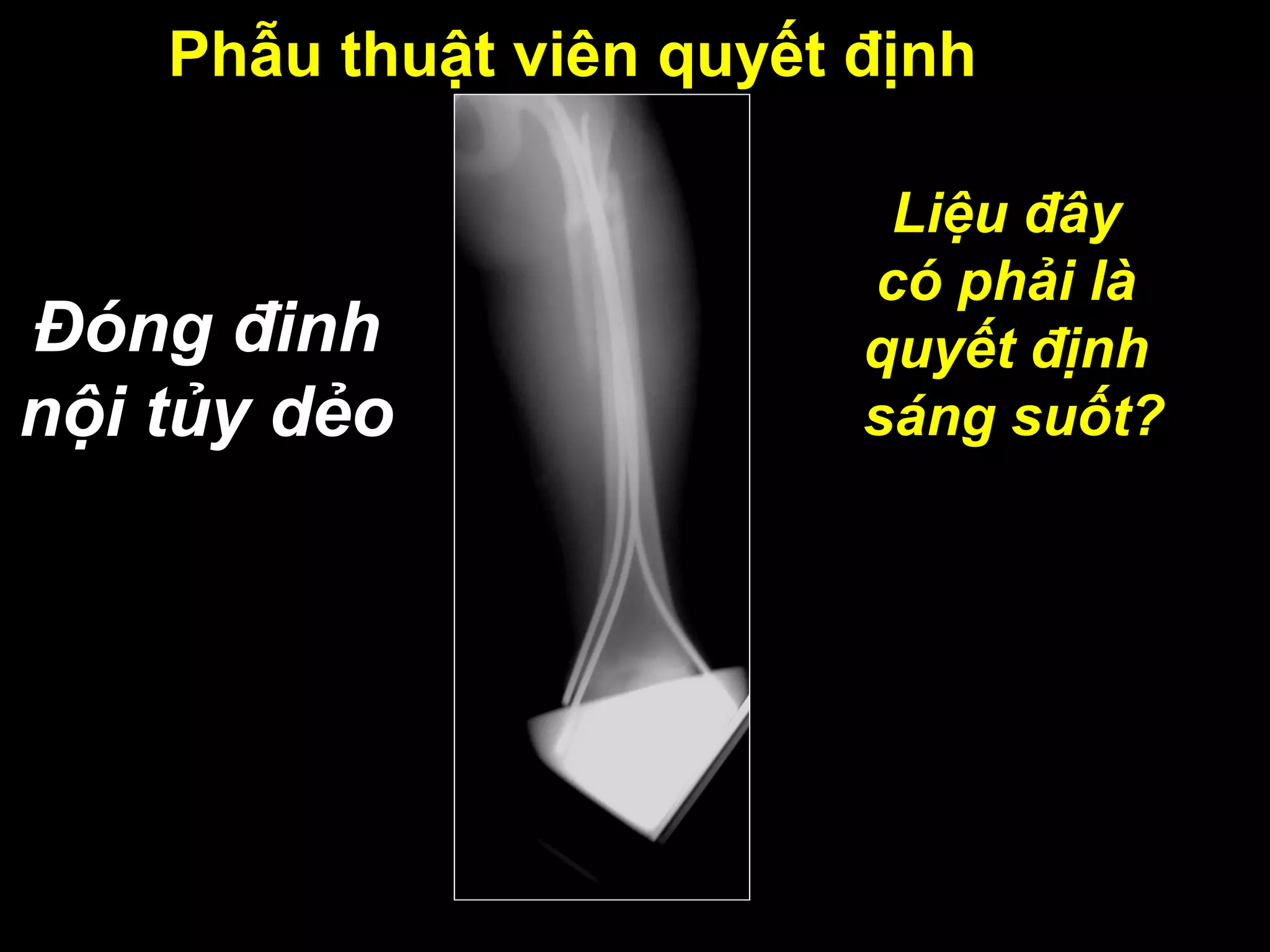 Phẫu thuật viên quyết định
Đóng đinh
nội tủy dẻo
Liệu đây
có phải là
quyết định
sáng suốt?
 