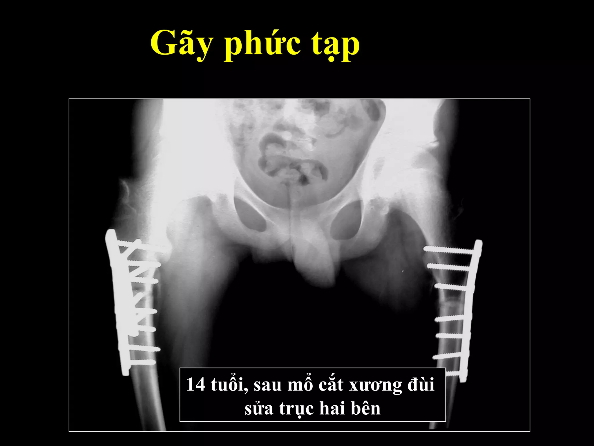 Gãy phức tạp
14 tuổi, sau mổ cắt xương đùi
sửa trục hai bên
 
