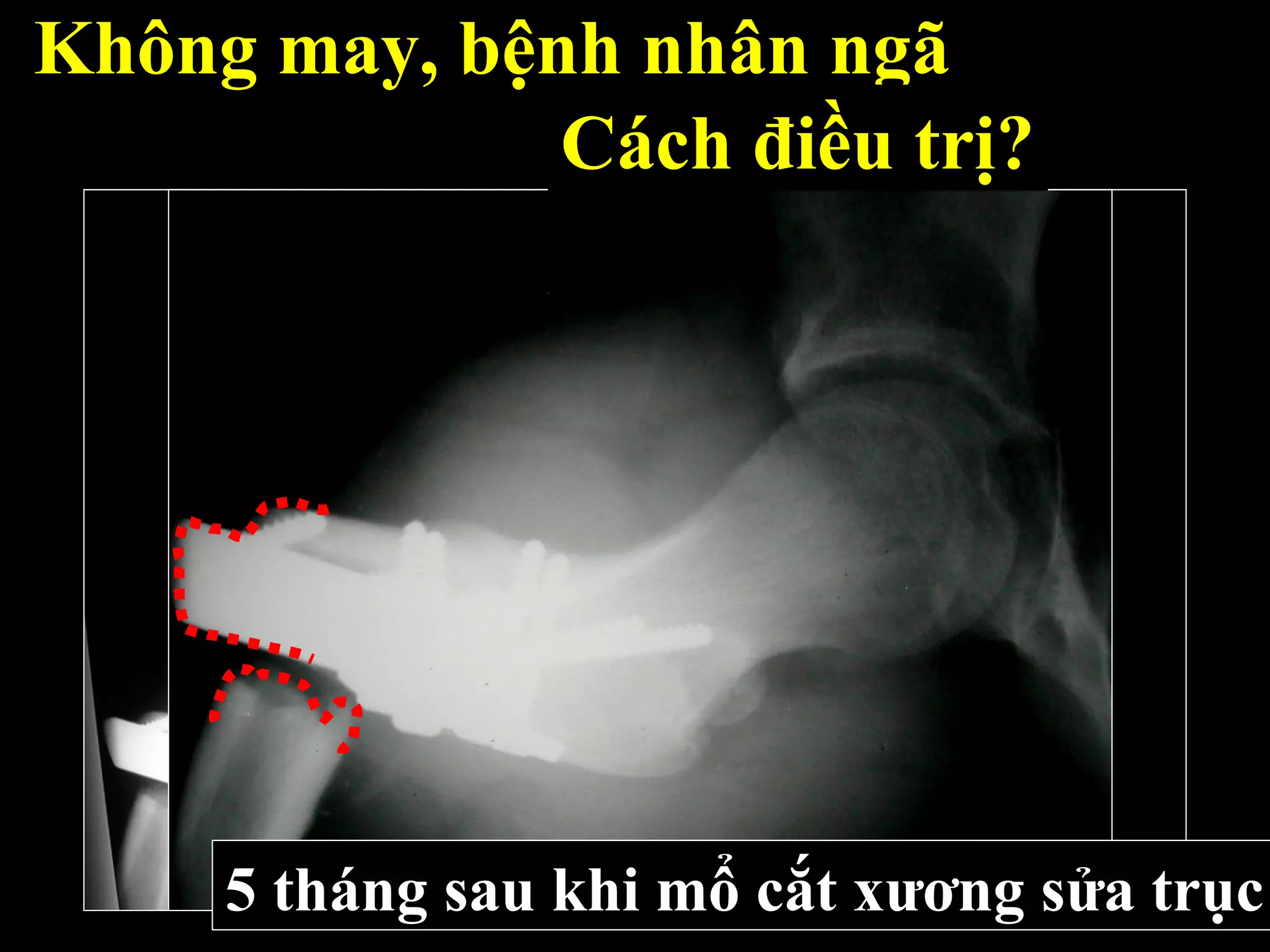 Không may, bệnh nhân ngã
Cách điều trị?
5 tháng sau khi mổ cắt xương sửa trục
 