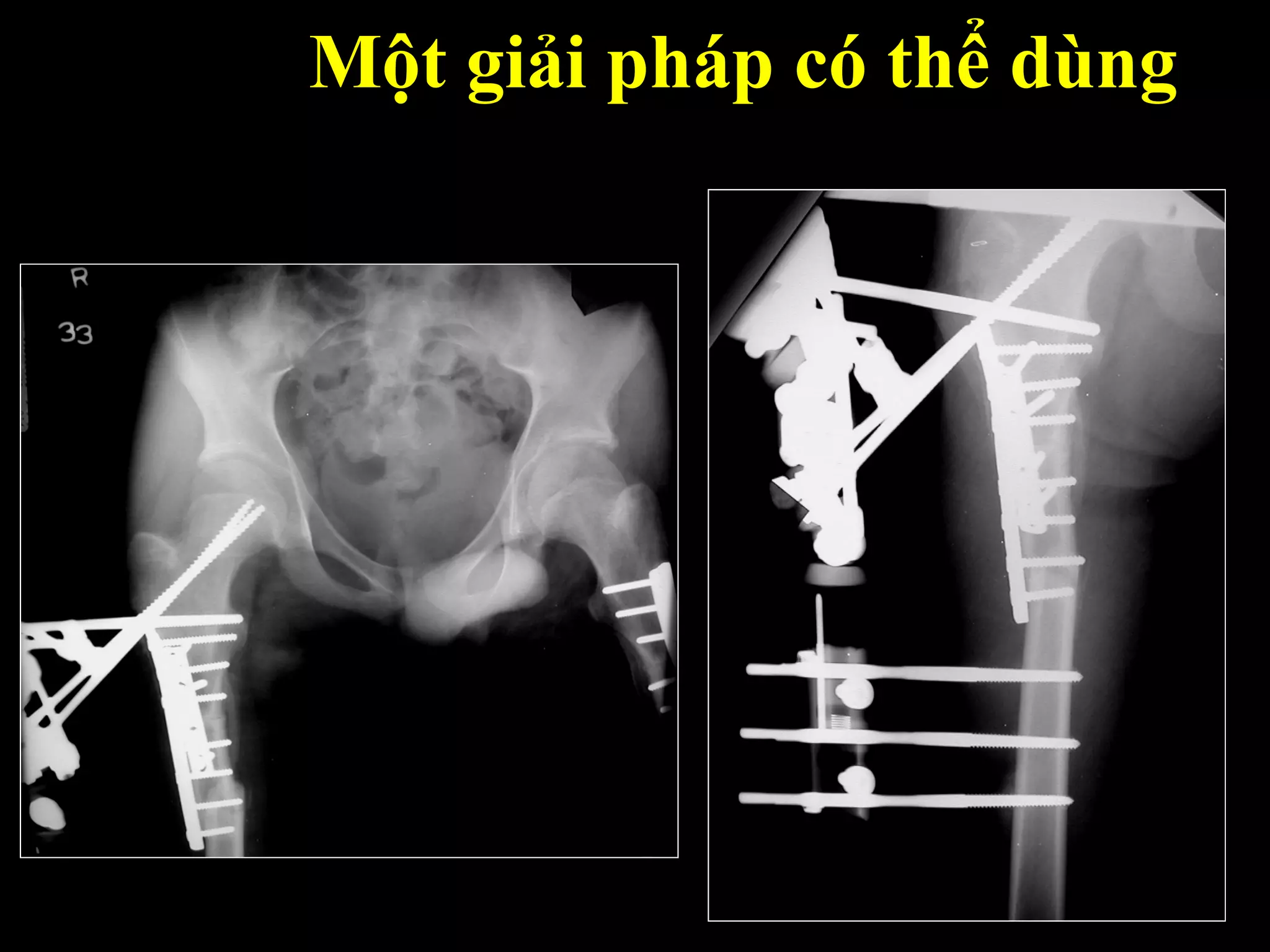 Một giải pháp có thể dùng
 