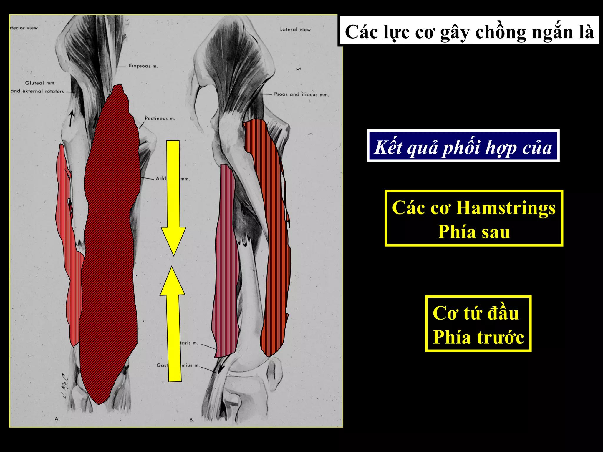 Các lực cơ gây chồng ngắn là
Kết quả phối hợp của
Các cơ Hamstrings
Phía sau
Cơ tứ đầu
Phía trước
 