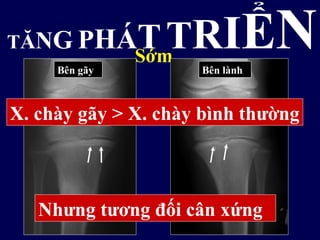 TĂNG PHÁTTRIỂNSớm
Bên gãy Bên lành
X. chày gãy > X. chày bình thường
Nhưng tương đối cân xứng
 
