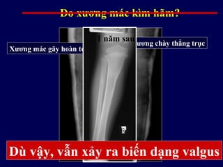 Do xương mác kìm hãm?
Xương chày thẳng trục
Xương mác gãy hoàn toàn
Dù vậy, vẫn xảy ra biến dạng valgus
1 năm sau
 