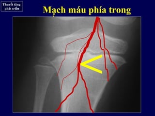 Thuyết tăng
phát triển
Mạch máu phía trong
dồi dào hơn (Ogden)
<
 