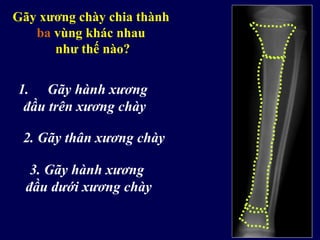 Gãy xương chày chia thành
ba vùng khác nhau
như thế nào?
1. Gãy hành xương
đầu trên xương chày
2. Gãy thân xương chày
3. Gãy hành xương
đầu dưới xương chày
 