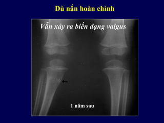 Dù nắn hoàn chỉnh
1 năm sau
Vẫn xảy ra biến dạng valgus
 