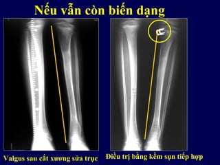 Nếu vẫn còn biến dạng
Valgus sau cắt xương sửa trục Điều trị bằng kềm sụn tiếp hợp
 