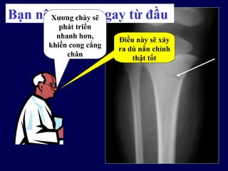 Điều này sẽ xảy
ra dù nắn chỉnh
thật tốt
Bạn nên nói gì ngay từ đầuXương chày sẽ
phát triển
nhanh hơn,
khiến cong cẳng
chân
 