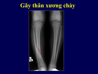 Gãy thân xương chày
 