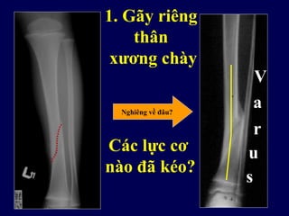 1. Gãy riêng
thân
xương chày
Nghiêng về đâu?
V
a
r
u
s
Các lực cơ
nào đã kéo?
 