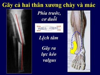Lệch tâm
Gây ra
lực kéo
valgus
Đường gãy ngangPhía trước,
cơ duỗi
Gãy cả hai thân xương chày và mác
 