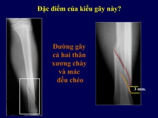 Đặc điểm của kiểu gãy này?
3 mm.
Đường gãy
cả hai thân
xương chày
và mác
đều chéo
 