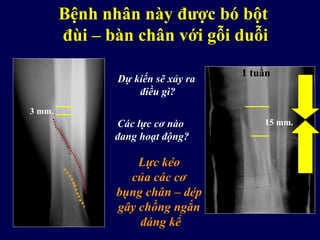 Bệnh nhân này được bó bột
đùi – bàn chân với gỗi duỗi
3 mm.
15 mm.
Lực kéo
của các cơ
bụng chân – dép
gây chồng ngắn
đáng kể
1 tuần
Dự kiến sẽ xảy ra
điều gì?
Các lực cơ nào
đang hoạt động?
 