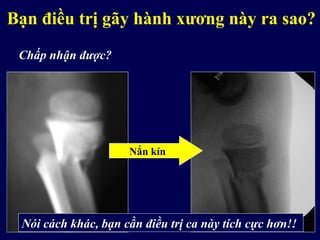 Bạn điều trị gãy hành xương này ra sao?
Nắn kín
Chấp nhận được?
Nói cách khác, bạn cần điều trị ca này tích cực hơn!!
 