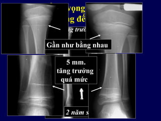 Có thể hy vọng hiện tượng
tăng trưởng đến mức nào?
2 năm sau
Xương chày tăng trưởng quá mức rất ít
Gần như bằng nhau
5 mm.
tăng trưởng
quá mức
 