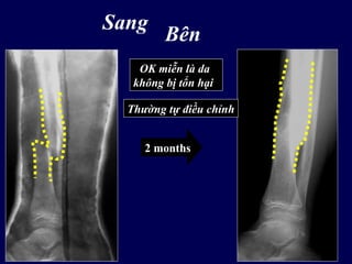 Sang
Bên
2 months
OK miễn là da
không bị tổn hại
Thường tự điều chỉnh
 