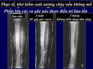 1. Gãy thân xương chày đơn thuần
Phần lớn các ca gãy này được điều trị bảo tồn
Thực tế, khó kiểm soát xương chày nếu không mổ
Sau nắn 2 tuần
100
gập góc varus
3 tháng
Không biến dạng lâm sàng
 
