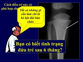 Cách điều trị này có
phù hợp cho ca gãy này?
Bạn có biết tình trạng
đứa trẻ sau 6 tháng?
Đây là ca gãy
đơn giản,
không di lệch
Tất cả những gì
cần làm chỉ là
bó bột đùi bàn
chân
 