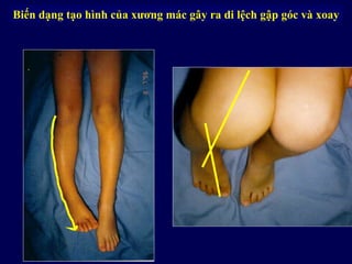Biến dạng tạo hình của xương mác gây ra di lệch gập góc và xoay
 