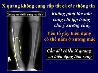 Xương mác biến dạng tạo hình
X quang không cung cấp tất cả các thông tin
Không phải lúc nào
cũng chỉ tập trung
chú ý xương chày
Yếu tố gây biến dạng
có thể nằm ở xương mác
Cần đối chiếu X quang
với biến dạng lâm sàng
 