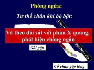 Phòng ngừa:
Tư thế chân khi bó bột:
Gối gập
Cổ chân gập lòng
Làm
chùngkhốicơbụngchân
–dép
Và theo dõi sát với phim X quang,
phát hiện chồng ngắn
 