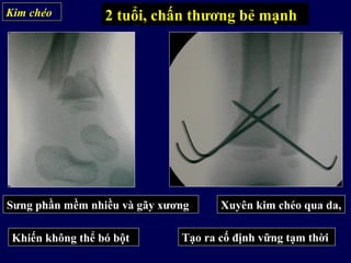 Kim chéo 2 tuổi, chấn thương bẻ mạnh
Sưng phần mềm nhiều và gãy xương
Khiến không thể bó bột
Xuyên kim chéo qua da,
Tạo ra cố định vững tạm thời
 