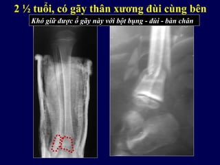 2 ½ tuổi, có gãy thân xương đùi cùng bên
Khó giữ được ổ gãy này với bột bụng - đùi - bàn chân
 
