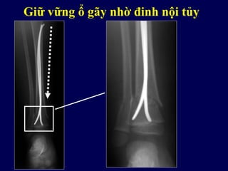 Giữ vững ổ gãy nhờ đinh nội tủy
 