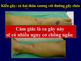 10 tuổi, sưng nhiều và nổi bóng nướcKiểu gãy: cả hai thân xương với đường gãy chéo
Cảm giác là ca gãy này
sẽ có nhiều nguy cơ chồng ngắn
 