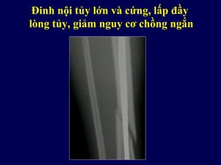 Đinh nội tủy lớn và cứng, lấp đầy
lòng tủy, giảm nguy cơ chồng ngắn
 