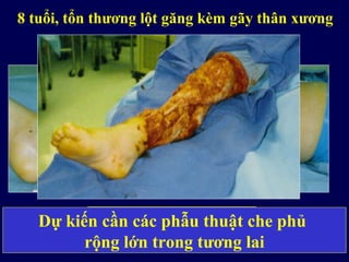 8 tuổi, tổn thương lột găng kèm gãy thân xương
Cần cắt lọc rộngDự kiến cần các phẫu thuật che phủ
rộng lớn trong tương lai
 