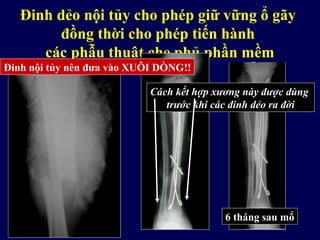 Làm thế nào để có thể cố định ổ gãy
mà không gây khó khăn cho các phẫu thuật
che phủ phần mềm trong tương lai?
Đinh dẻo nội tủy cho phép giữ vững ổ gãy
đồng thời cho phép tiến hành
các phẫu thuật che phủ phần mềm
Cách kết hợp xương này được dùng
trước khi các đinh dẻo ra đời
6 tháng sau mổ
Lỗi kỹ thuật nào khi dùng đinh nội tủy?Đinh nội tủy nên đưa vào XUÔI DÒNG!!
 