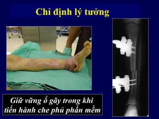 Bất động ngoàiChỉ định lý tưởng
Gãy hở kèm chèn ép khoangGiữ vững ổ gãy trong khi
tiến hành che phủ phần mềm
 