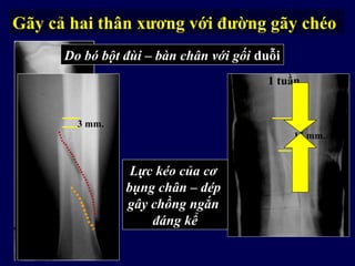 Tốt cho việc khôi phục chiều dài
3 mm.
Do bó bột đùi – bàn chân với gối duỗi
15 mm.
Lực kéo của cơ
bụng chân – dép
gây chồng ngắn
đáng kể
1 tuần
Gãy cả hai thân xương với đường gãy chéo
 