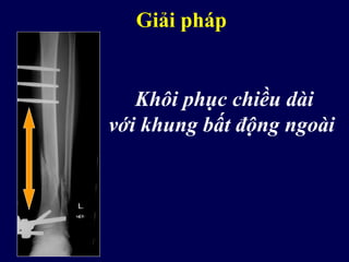 Khôi phục chiều dài
với khung bất động ngoài
Giải pháp
 