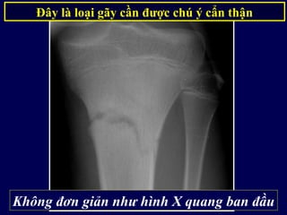 Đây là loại gãy cần được chú ý cẩn thận
Không đơn giản như hình X quang ban đầu
 