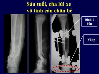 Gãy nát phía dưới có thể cần
khung bất động ngoài lai
Sáu tuổi, cha lùi xe
vô tình cán chân bé
Đinh 1
bên
Vòng
 