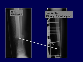 15 tuổi
Gãy hở độ II
Sau cắt lọc
Khung cố định ngoài
 