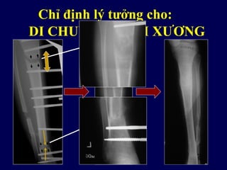 Kéo dài can
đoạn gần
Ép nơi mất
xương
Chỉ định lý tưởng cho:
DI CHUYỂN KHỐI XƯƠNG
 